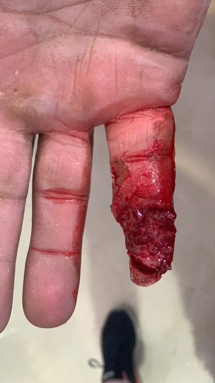 Fractura con amputación parcial y degloving del 5º dedo de la mano