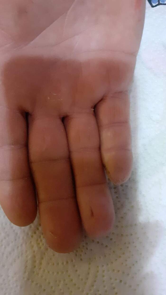 Fractura con amputación parcial y degloving del 5º dedo de la mano