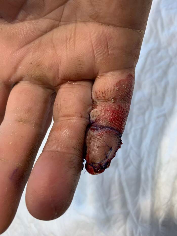 Fractura con amputación parcial y degloving del 5º dedo de la mano