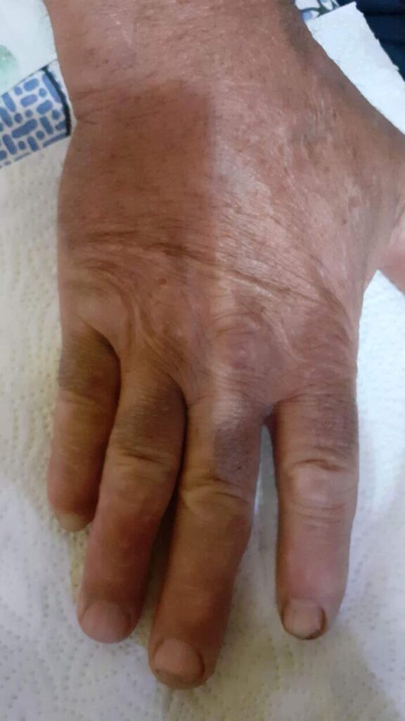 Fractura con amputación parcial y degloving del 5º dedo de la mano