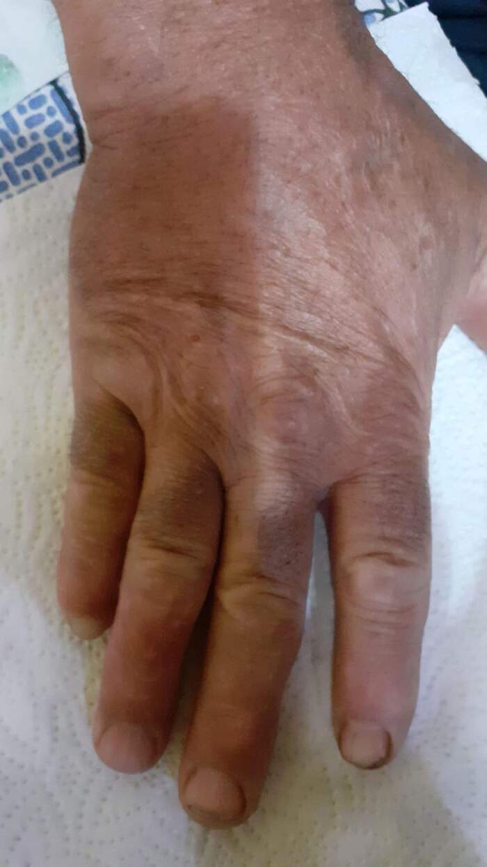 Fractura con amputación parcial y degloving del 5º dedo de la mano