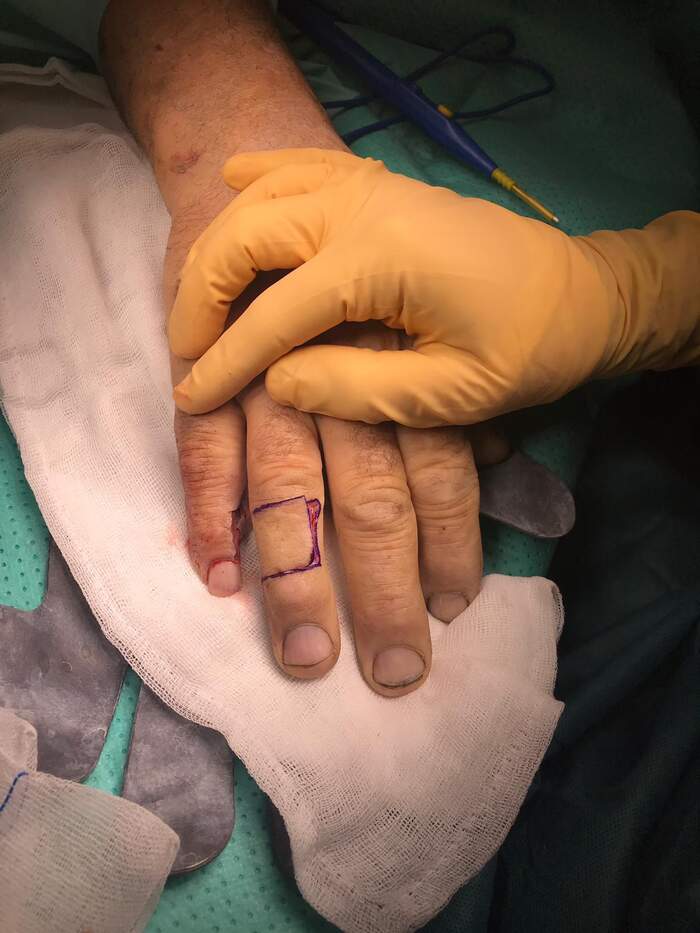 Fractura con amputación parcial y degloving del 5º dedo de la mano