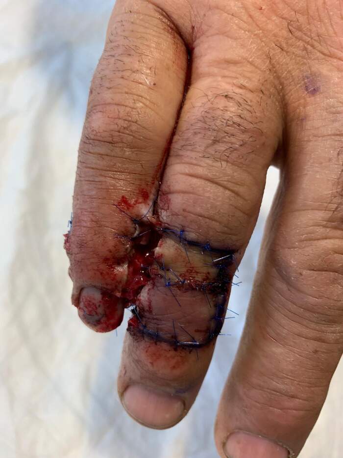 Fractura con amputación parcial y degloving del 5º dedo de la mano