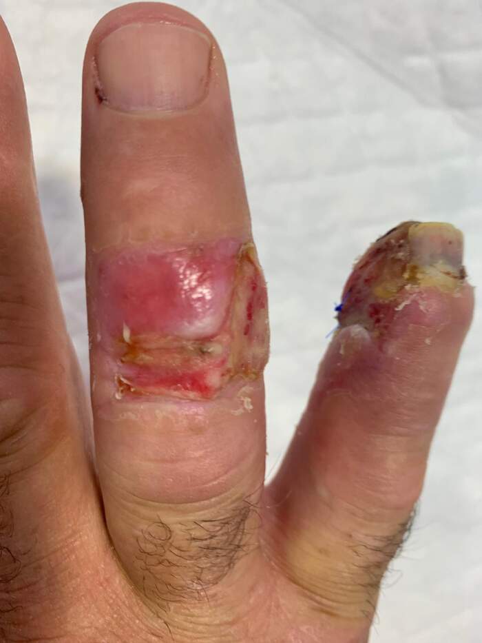 Fractura con amputación parcial y degloving del 5º dedo de la mano
