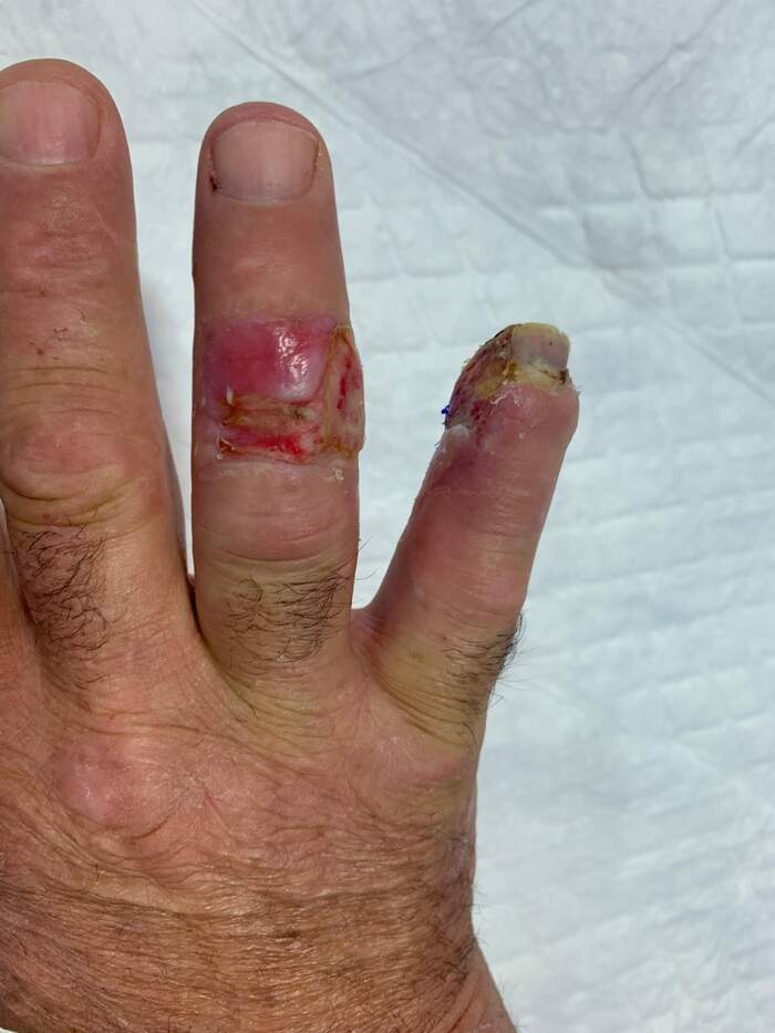 Fractura con amputación parcial y degloving del 5º dedo de la mano
