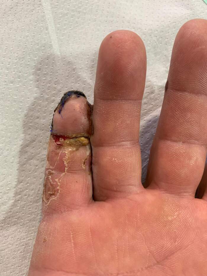 Fractura con amputación parcial y degloving del 5º dedo de la mano