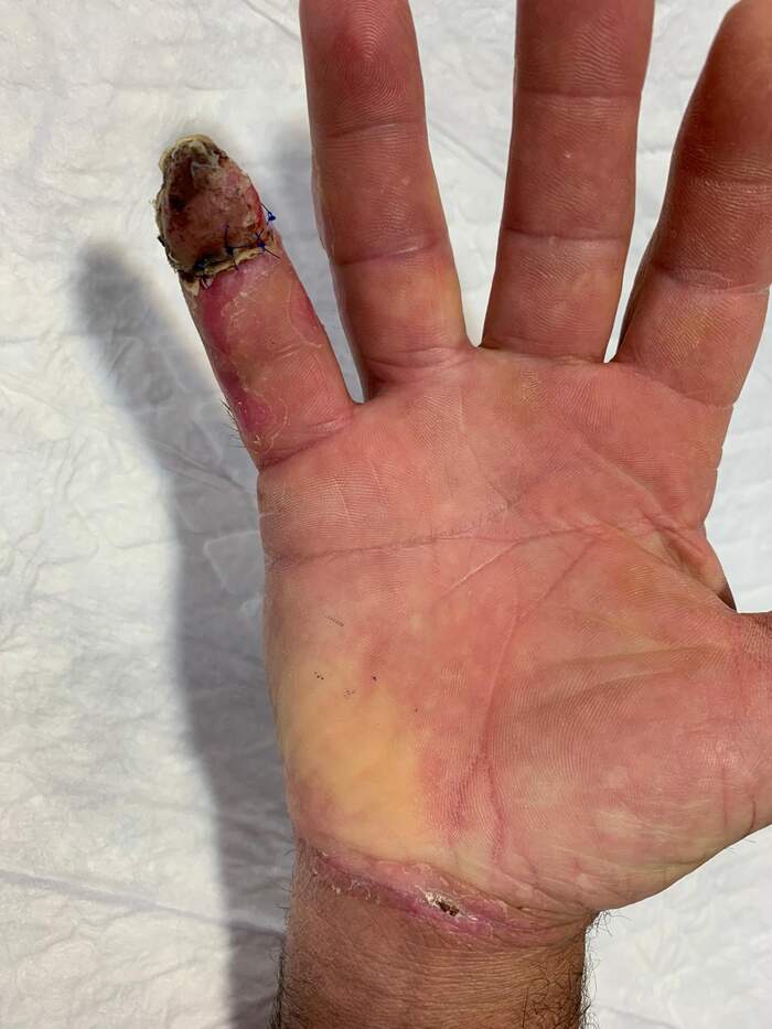 Fractura con amputación parcial y degloving del 5º dedo de la mano
