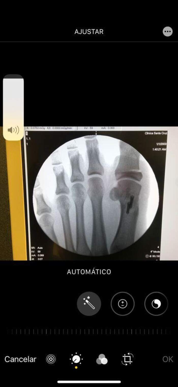 Corrección quirúrgica de deformidades del antepié