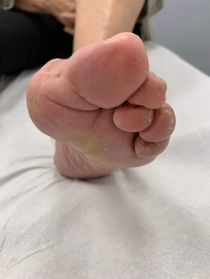 Reparación de desalineación metatarsal — caso complejo reoperado