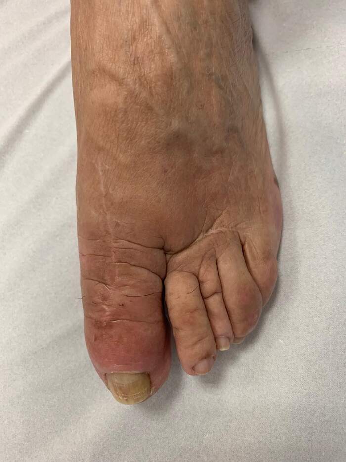 Reparación de desalineación metatarsal — caso complejo reoperado