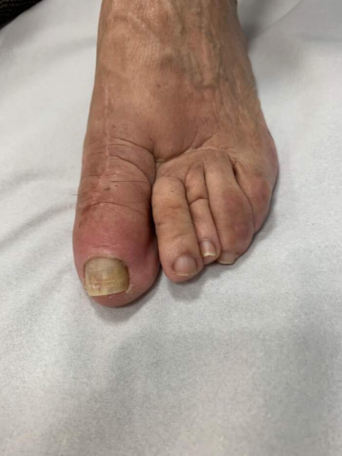 Reparación de desalineación metatarsal — caso complejo reoperado