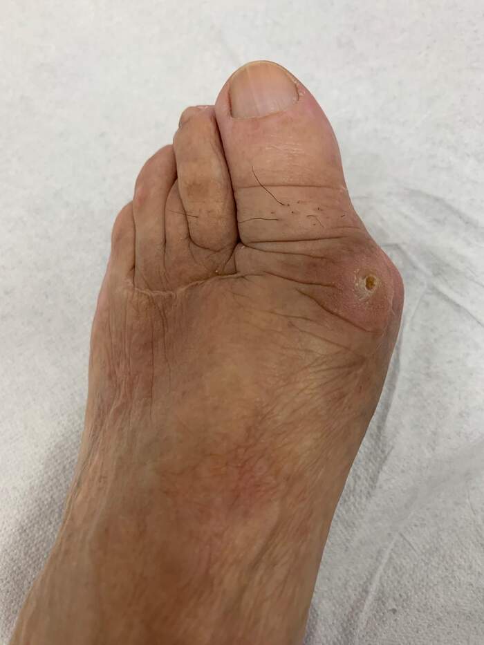 Reparación de desalineación metatarsal — caso complejo reoperado