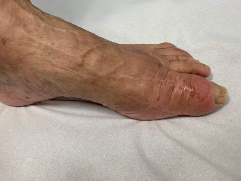 Reparación de desalineación metatarsal — caso complejo reoperado