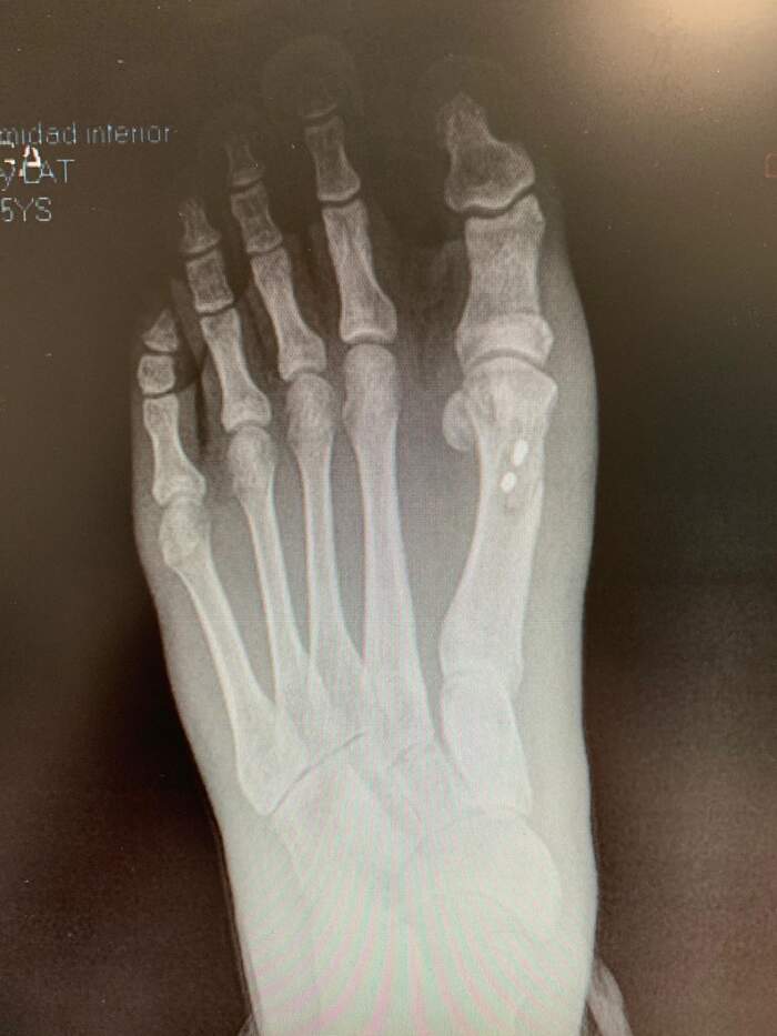 Reparación de desalineación metatarsal — caso complejo reoperado