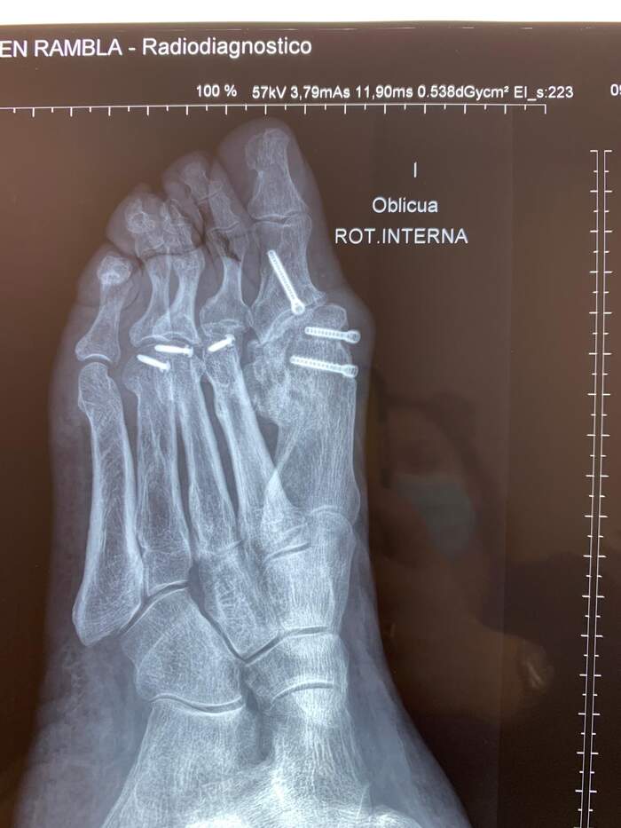 Reparación de desalineación metatarsal — caso complejo reoperado