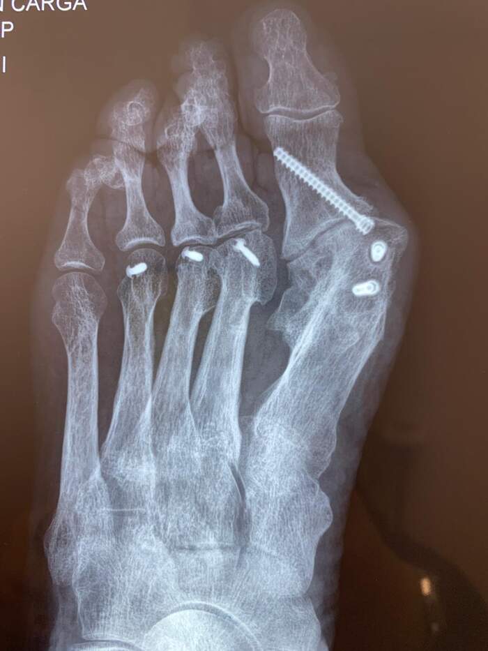 Reparación de desalineación metatarsal — caso complejo reoperado
