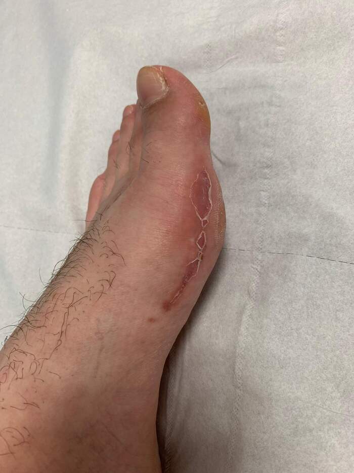 Reparación de desalineación metatarsal — caso complejo reoperado