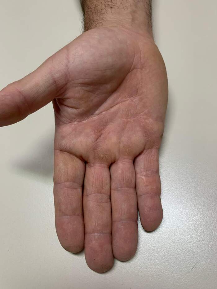Enfermedad de Dupuytren — fasciectomía palmar