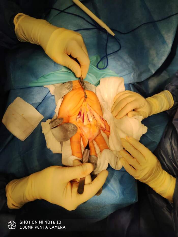 Enfermedad de Dupuytren — fasciectomía palmar