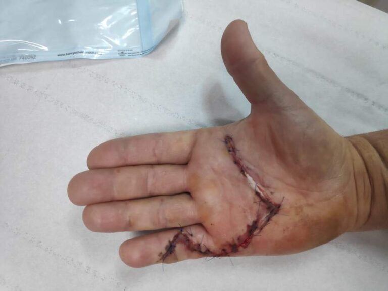 Enfermedad de Dupuytren — fasciectomía palmar
