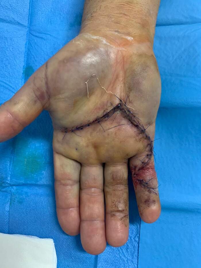 Enfermedad de Dupuytren — fasciectomía palmar