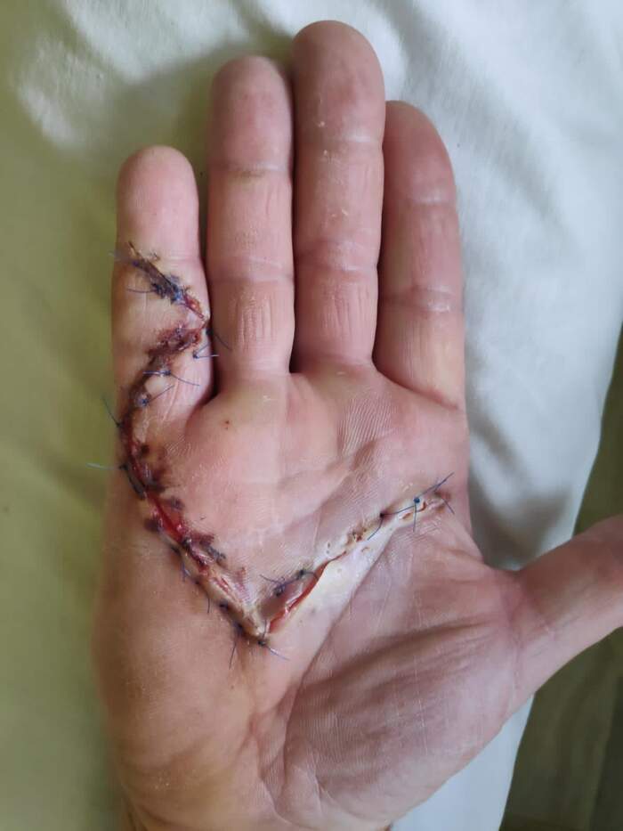 Enfermedad de Dupuytren — fasciectomía palmar