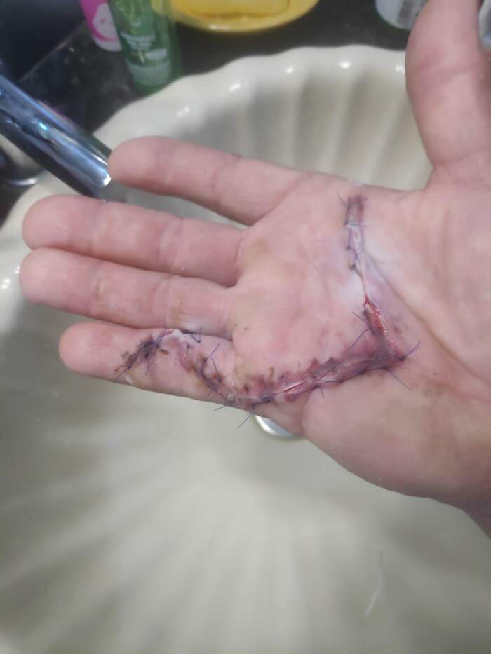Enfermedad de Dupuytren — fasciectomía palmar