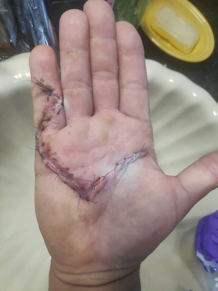 Enfermedad de Dupuytren — fasciectomía palmar