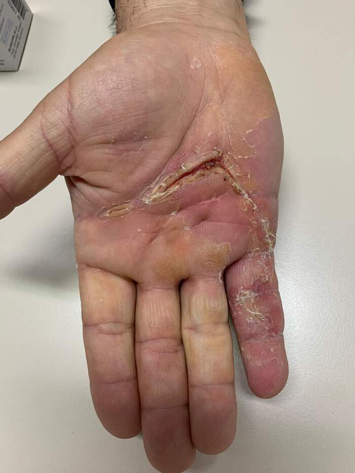 Enfermedad de Dupuytren — fasciectomía palmar