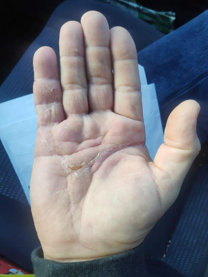 Enfermedad de Dupuytren — fasciectomía palmar