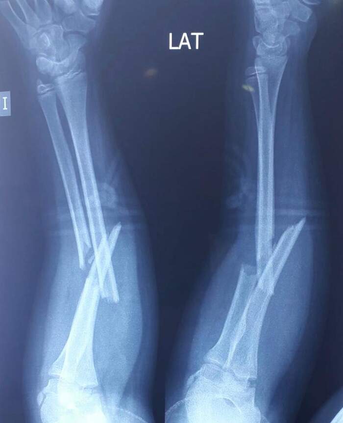 Fractura diafisaria de antebrazo (radio y cúbito)