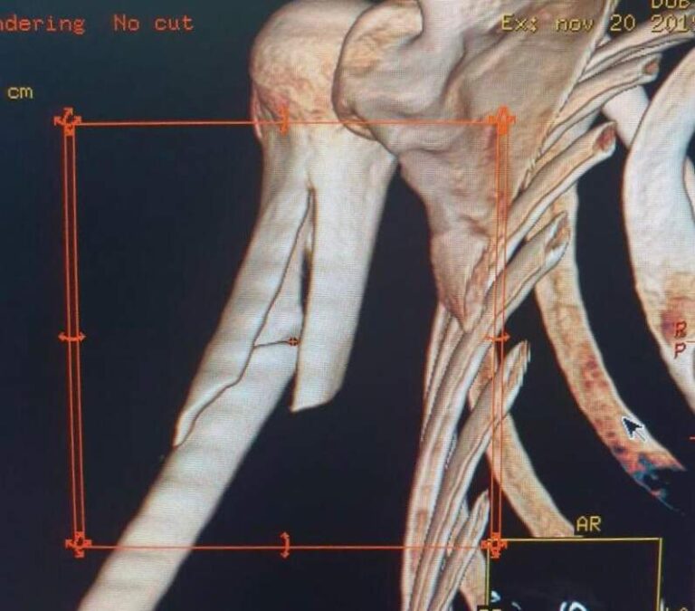 Fractura diafisaria de antebrazo (radio y cúbito)