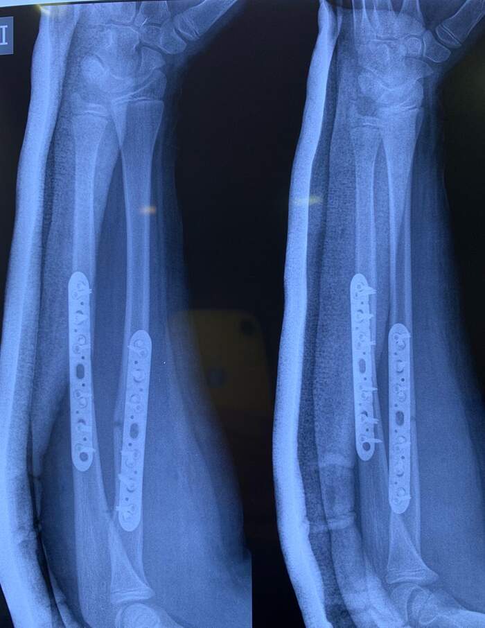 Fractura diafisaria de antebrazo (radio y cúbito)