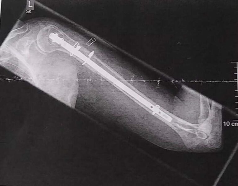 Fractura diafisaria de antebrazo (radio y cúbito)