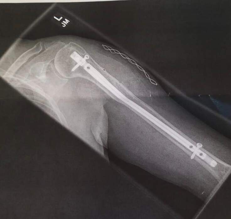 Fractura diafisaria de antebrazo (radio y cúbito)