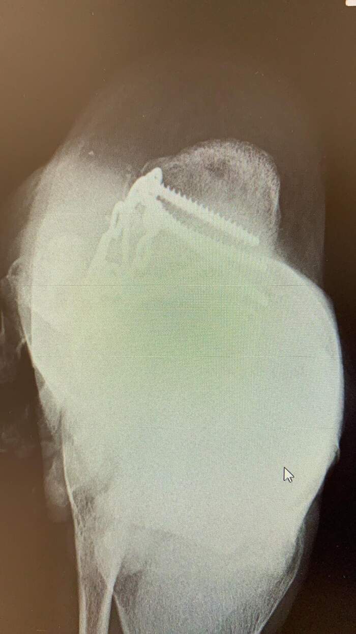 Fractura de calcáneo — reducción y osteosíntesis
