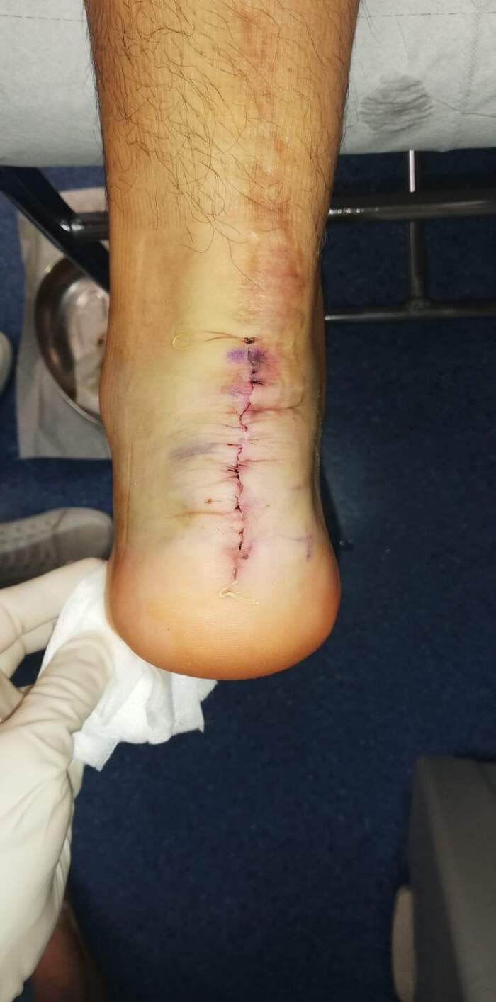 Fractura de calcáneo — reducción y osteosíntesis