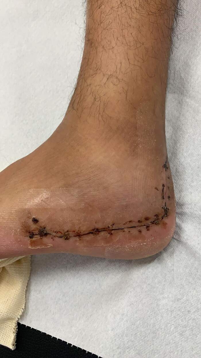 Fractura de calcáneo — reducción y osteosíntesis