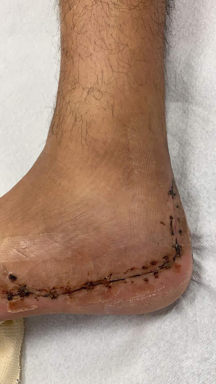Fractura de calcáneo — reducción y osteosíntesis
