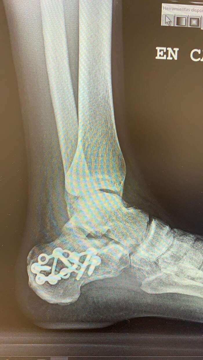 Fractura de calcáneo — reducción y osteosíntesis