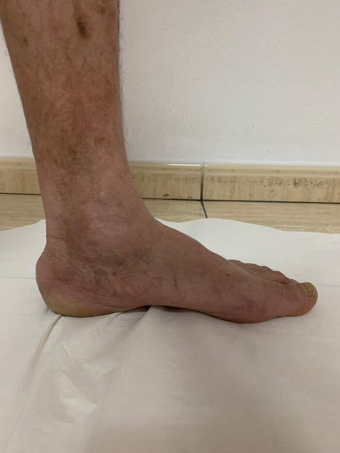 Fractura de calcáneo — reducción y osteosíntesis