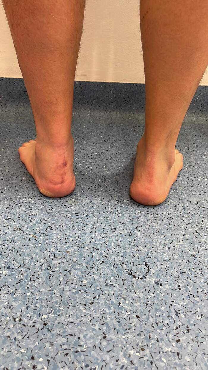 Fractura de calcáneo — reducción y osteosíntesis