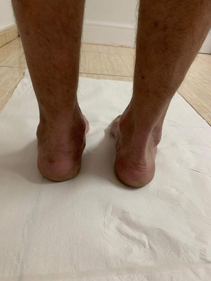 Fractura de calcáneo — reducción y osteosíntesis