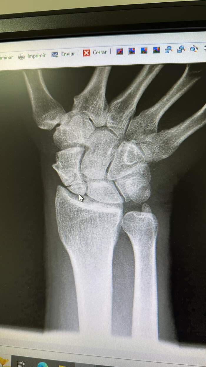 Fractura de escafoides carpiano — fijación quirúrgica