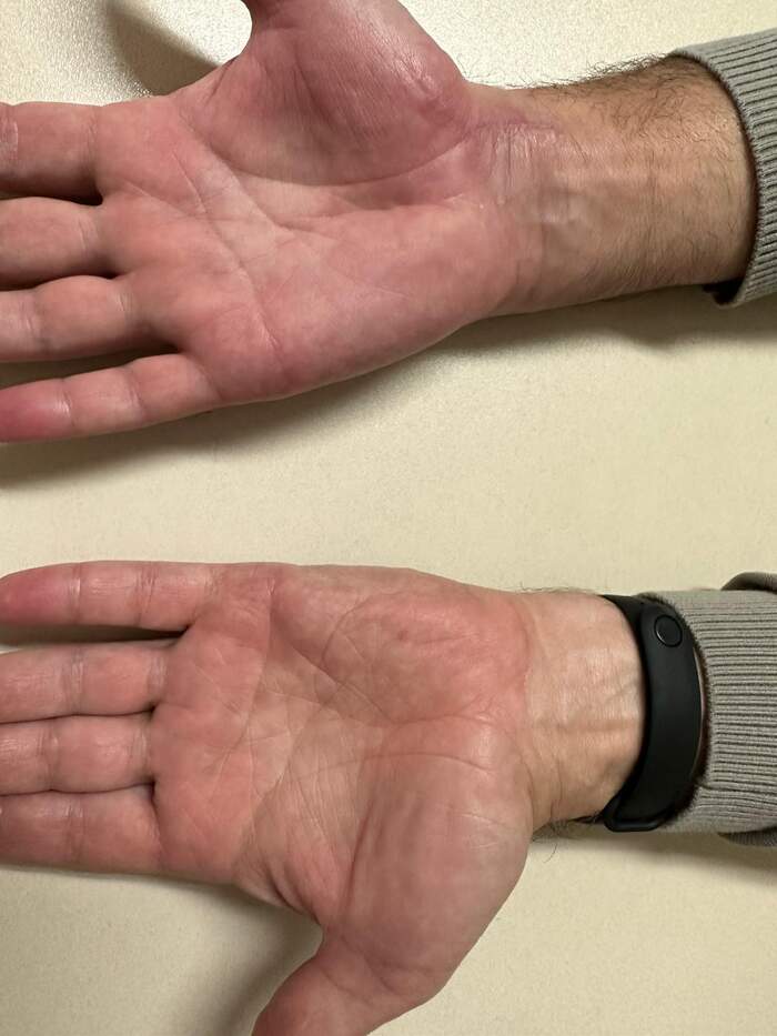 Fractura de escafoides carpiano — fijación quirúrgica