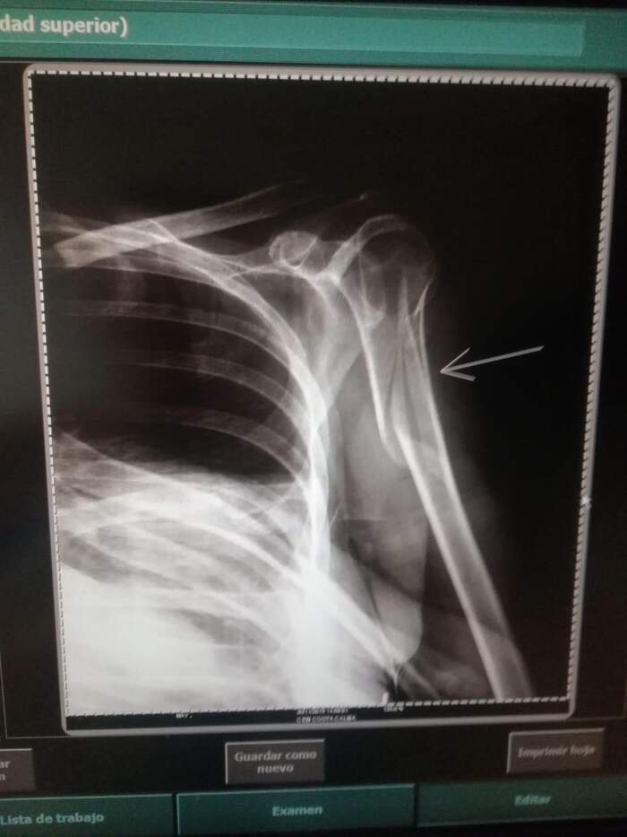 Fractura de húmero proximal