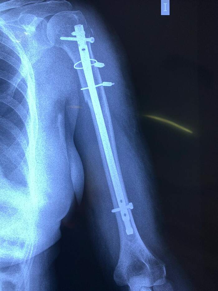 Fractura de húmero proximal