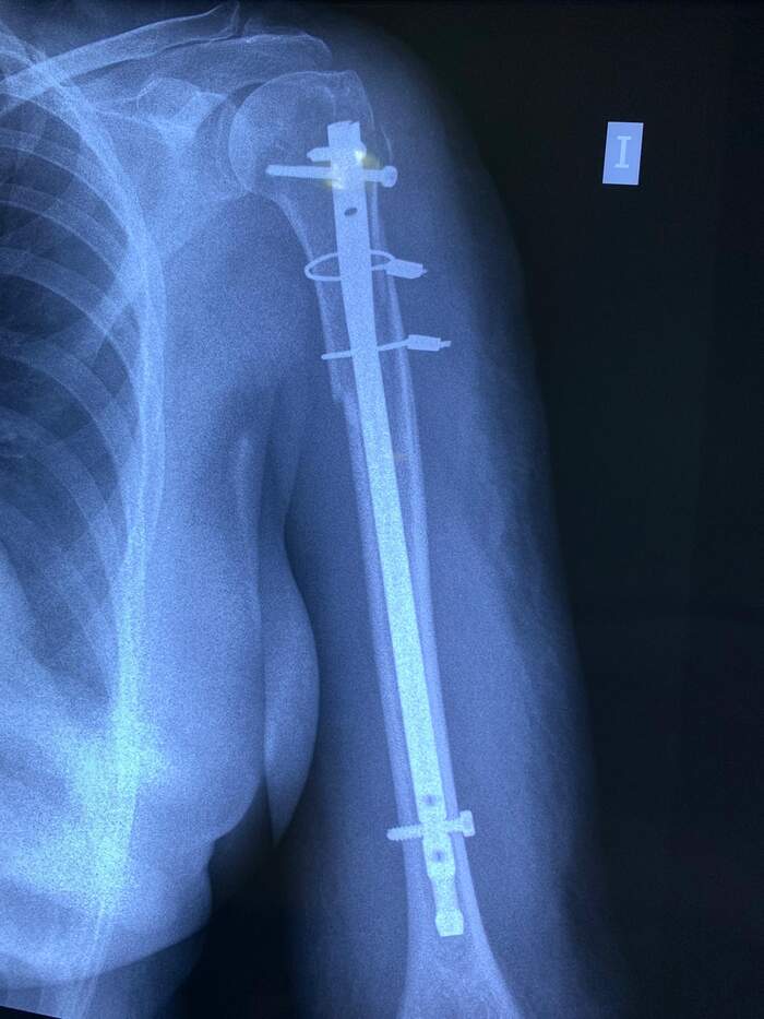 Fractura de húmero proximal