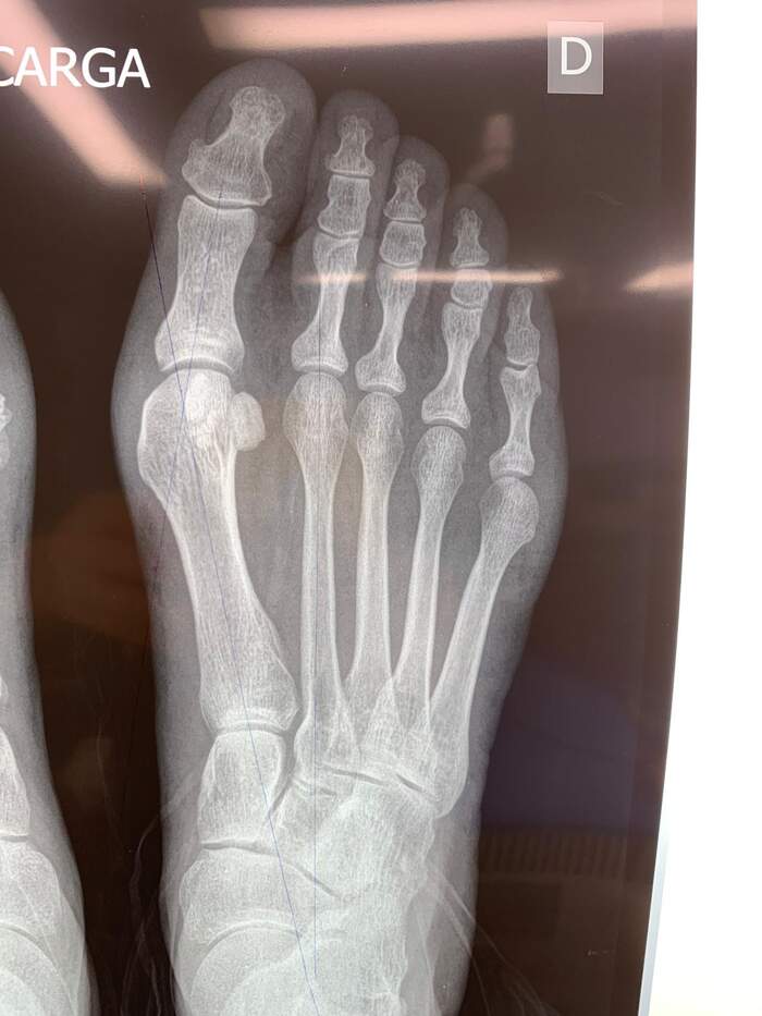 Hallux Valgus — corrección quirúrgica con excelente resultado