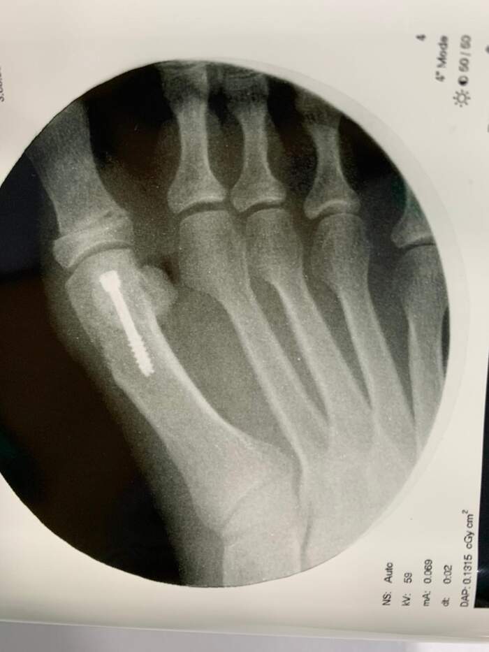 Hallux Valgus — corrección quirúrgica con excelente resultado